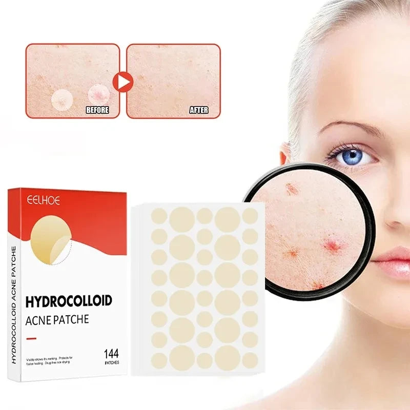 144-Piece Pimple Patches