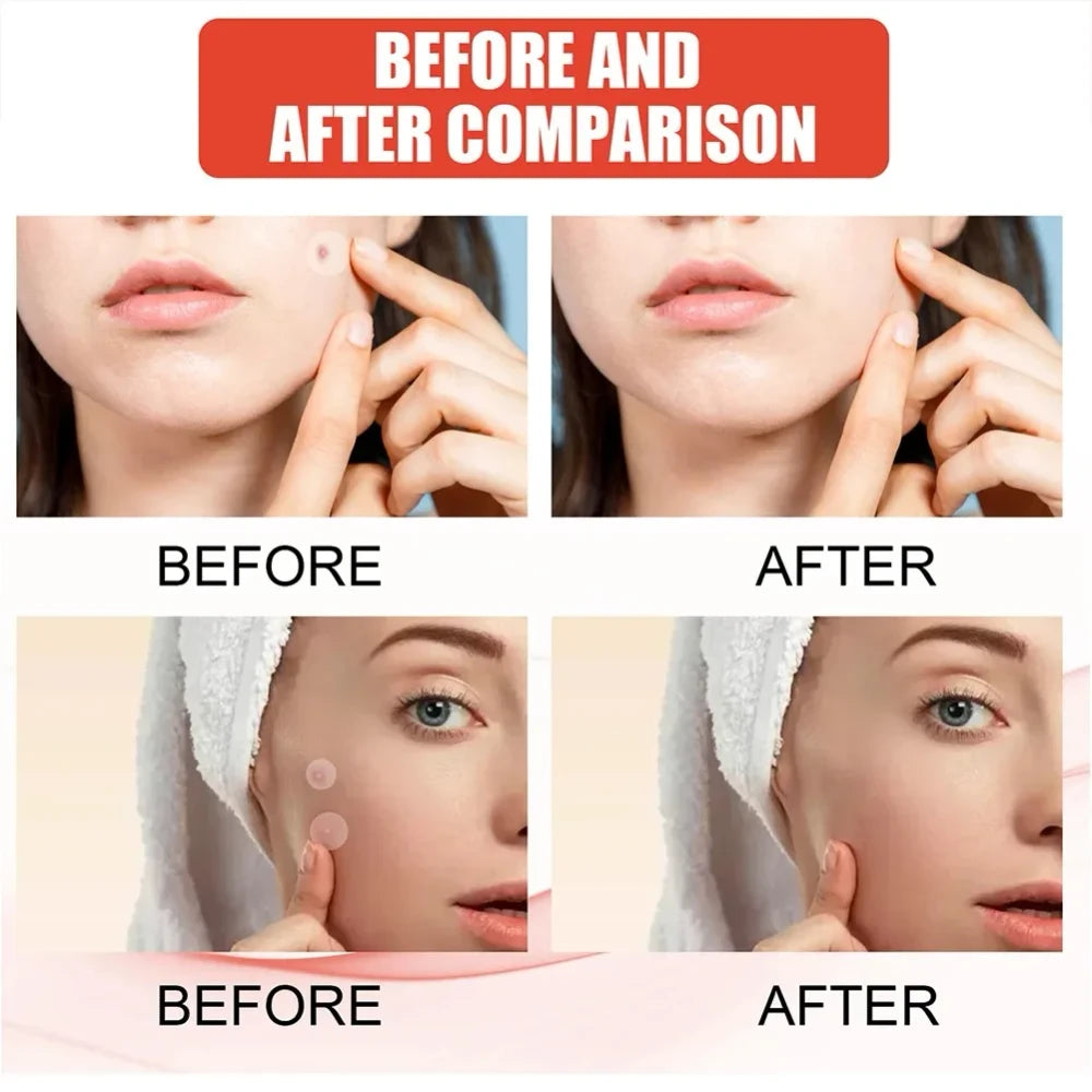 144-Piece Pimple Patches